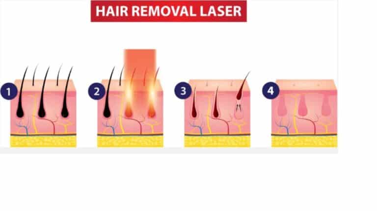 ποτε πεφτουν οι τριχες μετα το laser